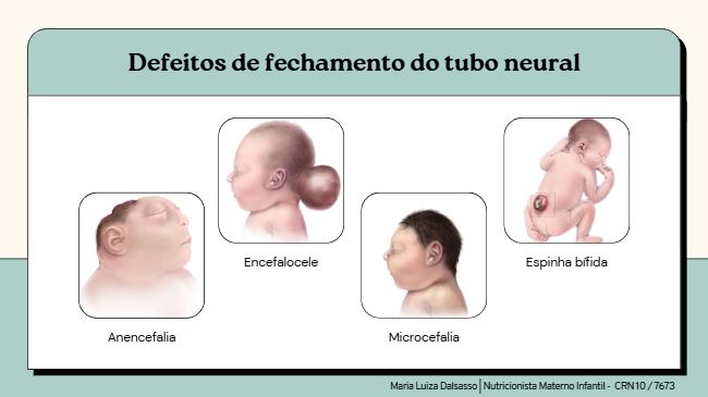 Defeitos de fechamento do tubo neural por falta de ácido fólico